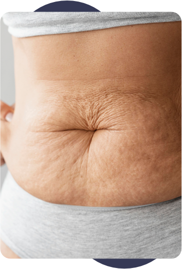 Diástase Abdominal